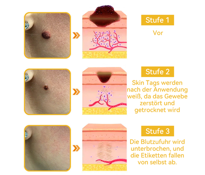 🔥 Nur noch 6 Boxen übrig! Extra 50% Rabatt! Dermatologisch getestet, 4-6 Sticks reichen aus, um Ihre Haut vollständig zu reparieren, ohne dass es zu Hautreizungen kommt. Verpassen Sie es nicht und warten Sie nicht ein weiteres Jahr! 💥